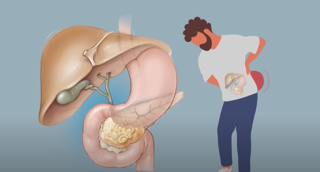Pancreatic Problems